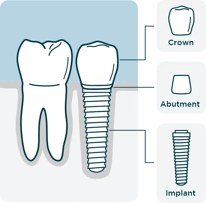 Anatomy of a Dental Implant