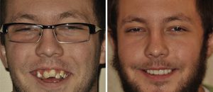 EON Clinics teeth implants before and after