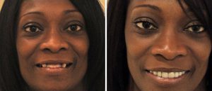 All-on-4 before and after dental implants patients