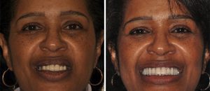 Teeth implants before and after photos of EON Clinics patient with full mouth implants