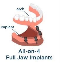 benefits of all on 4 dental implants