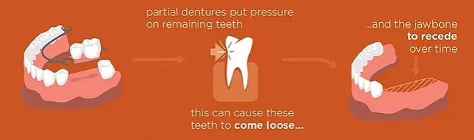 Comparing dentures cost and cost of implants