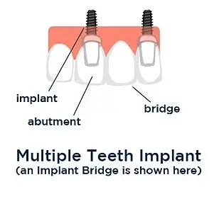 Multiple Tooth Implants and implanted teeth