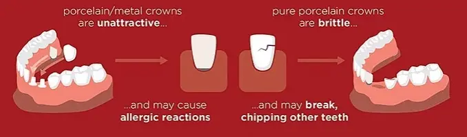 Comparing Cost of Implants & Crowns