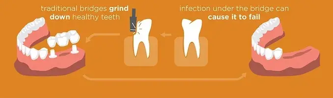 Implants & Dental Bridge - Cost Comparision