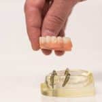 All-on-4 full jaw types of dental implants