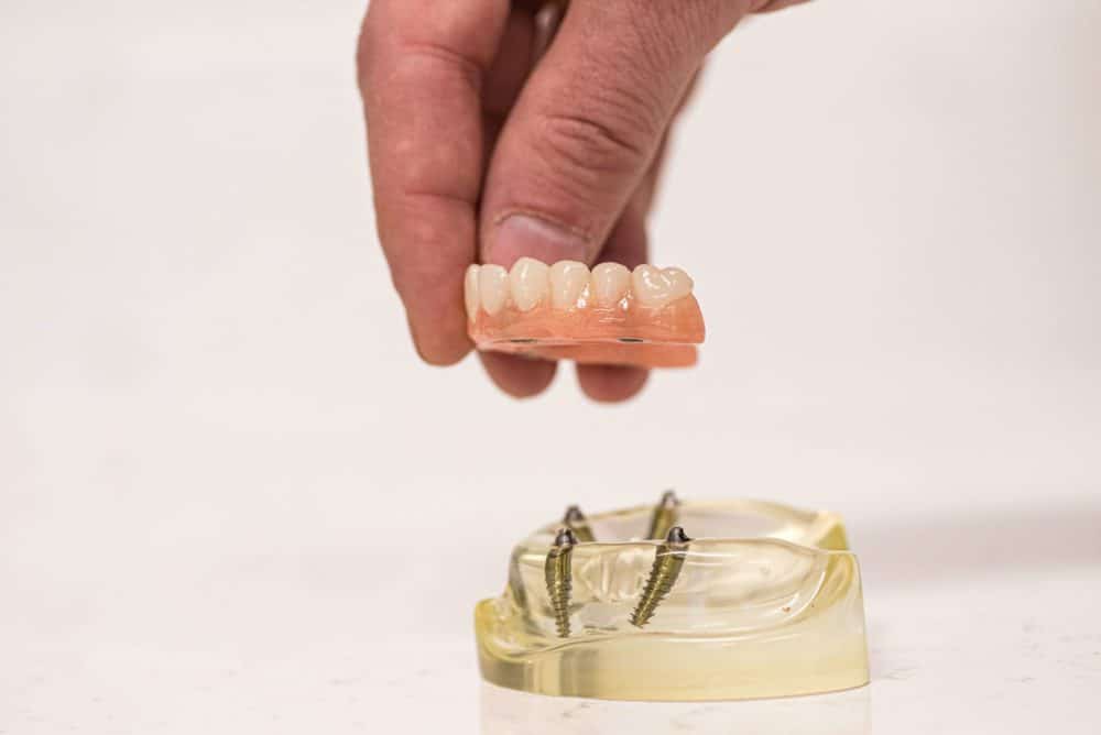 All-on-4 dental implant full jaw model