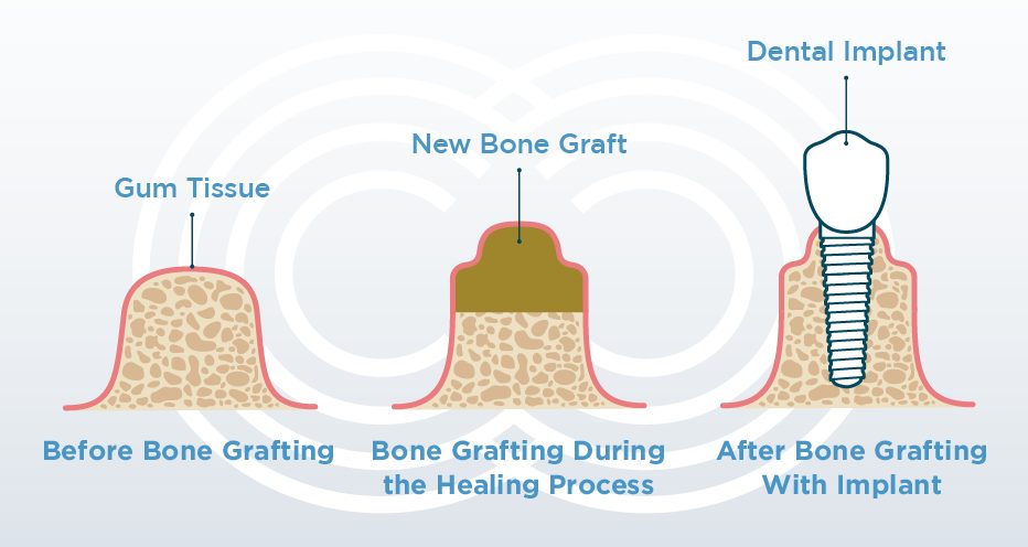 Bone Grafting : Can You Have Dental Implants With Bone Loss?