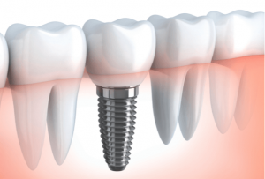 What Are the Benefits of Dental Implants