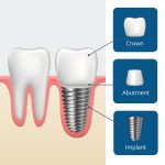 Dental implants and crown