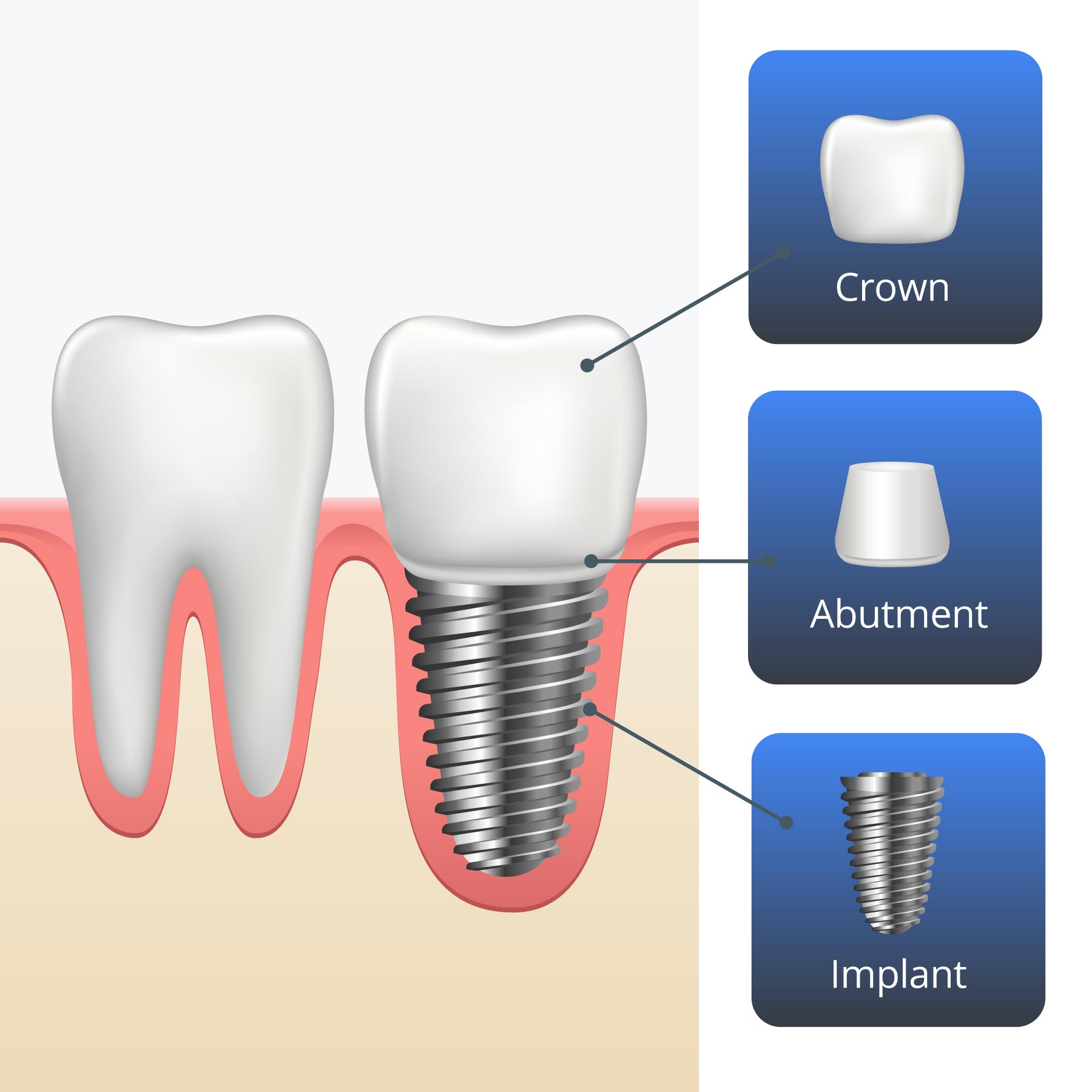 Cost of mini dental implants cost & Mini with implants dental cost comparisons