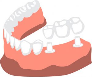 Illustration of a Traditional Dental Bridge
