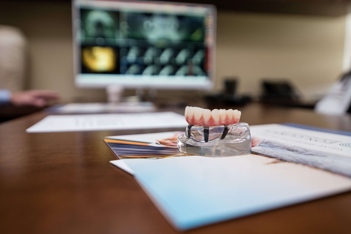 Are All-on-4 Dental Implants the Best Option?