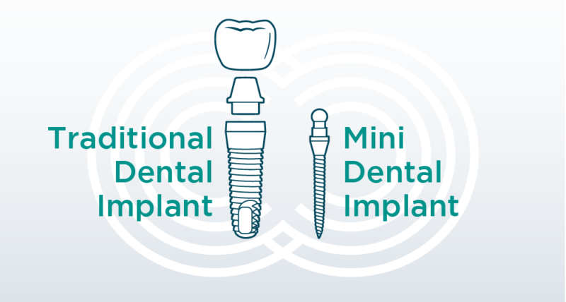 mini dental implant cost comparison diagram