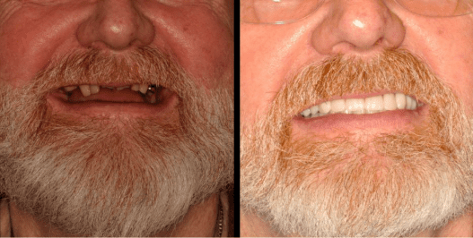 All on 4 before and after dental implants photos