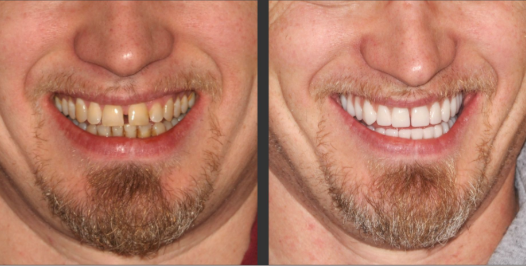 tooth implant before after