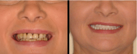 Patient before and after dental implants