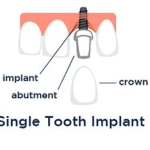 Single tooth implant cost Chicago