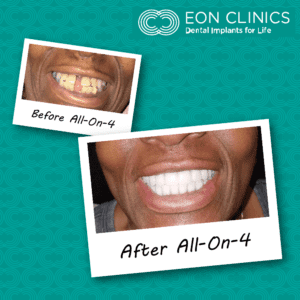EON Clinics Dental Implants Before and After Photos of Smile