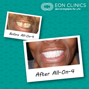 EON Clinics Dental Implants Before and After Photos of Smile