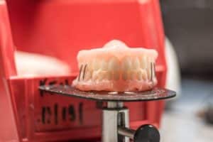 Model of same day dental implants