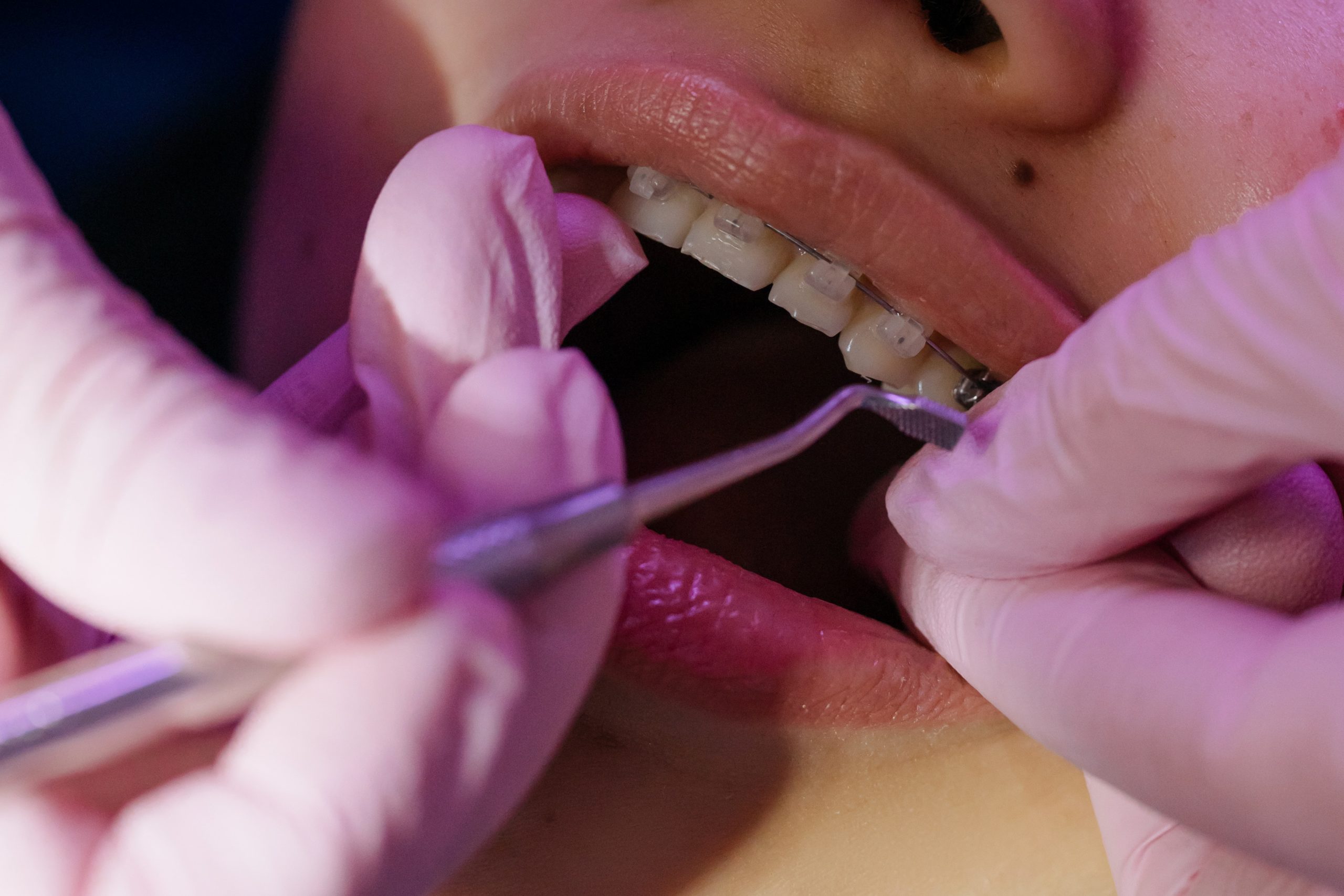 Dental Braces- Revolutionary Pathway To Get Straightened Teeth