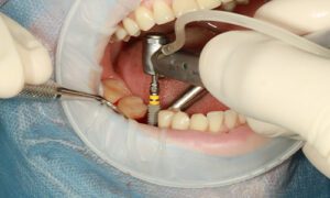 Comparing the Cost of Dental Implants & A Dental Bridge-Shaumburg