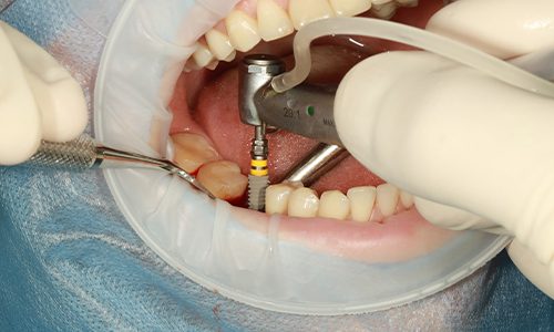 Placement of Dental Implants