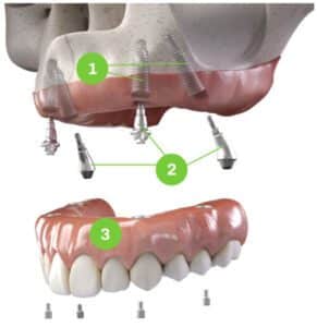 Permanent Dentures or Tooth Implants: Key Differences