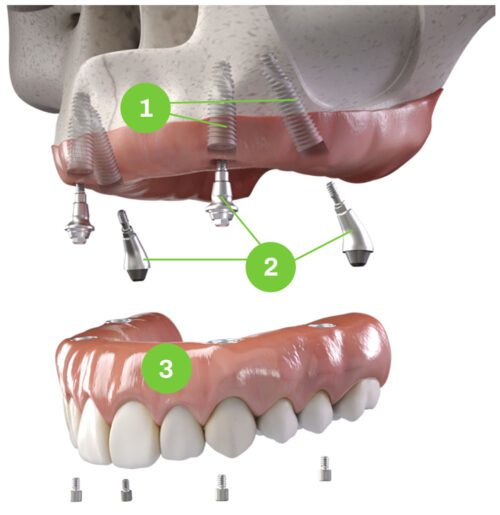 Comparing Cost of Dental Implants & A Dental Bridge-Munster
